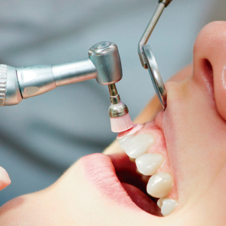 What Are Dental Prophylaxis at lenardfdleckman blog